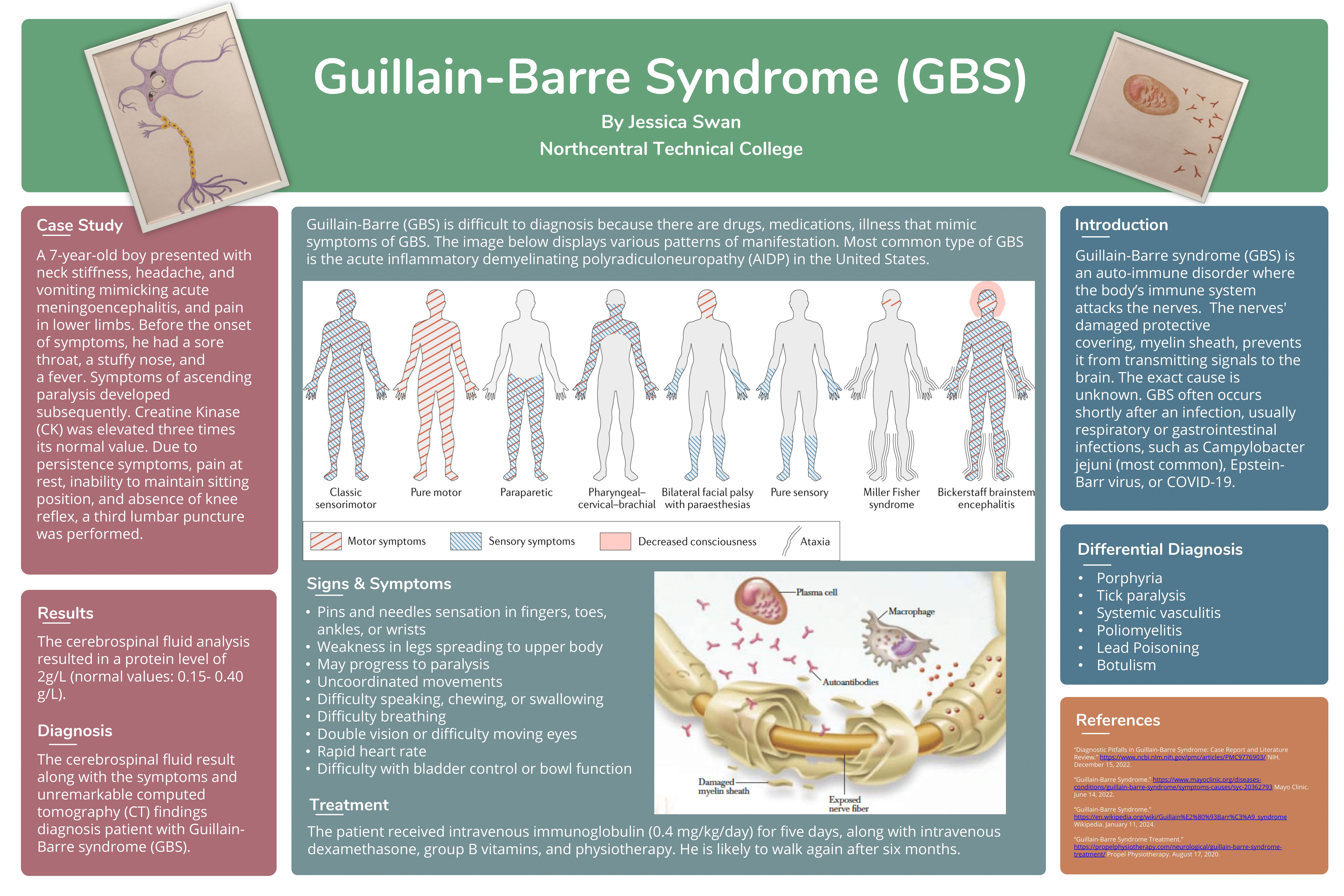 Guillain-Barre Syndrome (BGS) poster by Jessica Swan